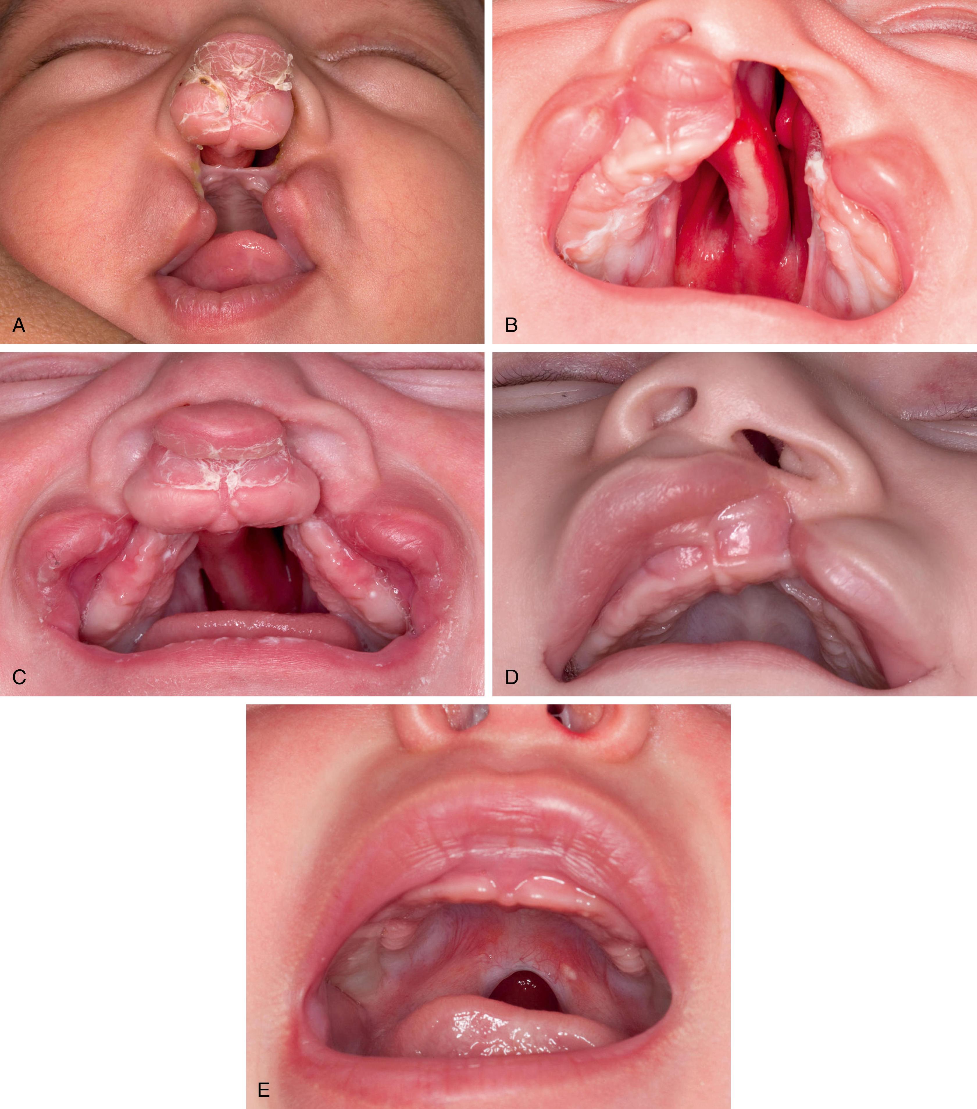 Fig. 17.1, Clinical images of permutations of the clefting process, given the distinct embryologic origin of lip and primary palate and of the secondary palate. (A) Complete bilateral cleft lip and primary palate. (B) Complete/incomplete cleft lip and primary palate and complete cleft of secondary palate. (C) Complete bilateral cleft lip, primary and secondary palates. (D) Incomplete cleft lip and primary palate. (E) Incomplete cleft of secondary palate.