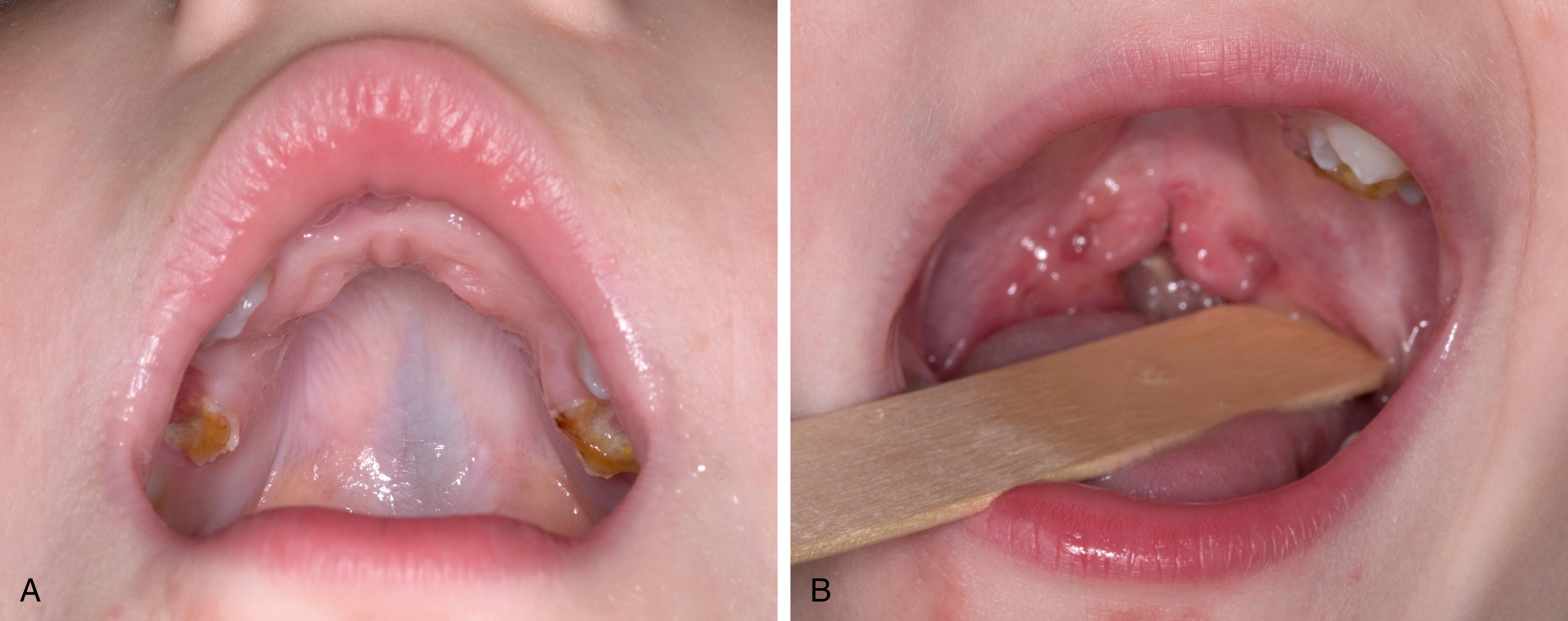 Fig. 17.3, (A) Clinical image of an overt submucous cleft palate, (B) demonstrating the zona pellucidum and bifid uvula.
