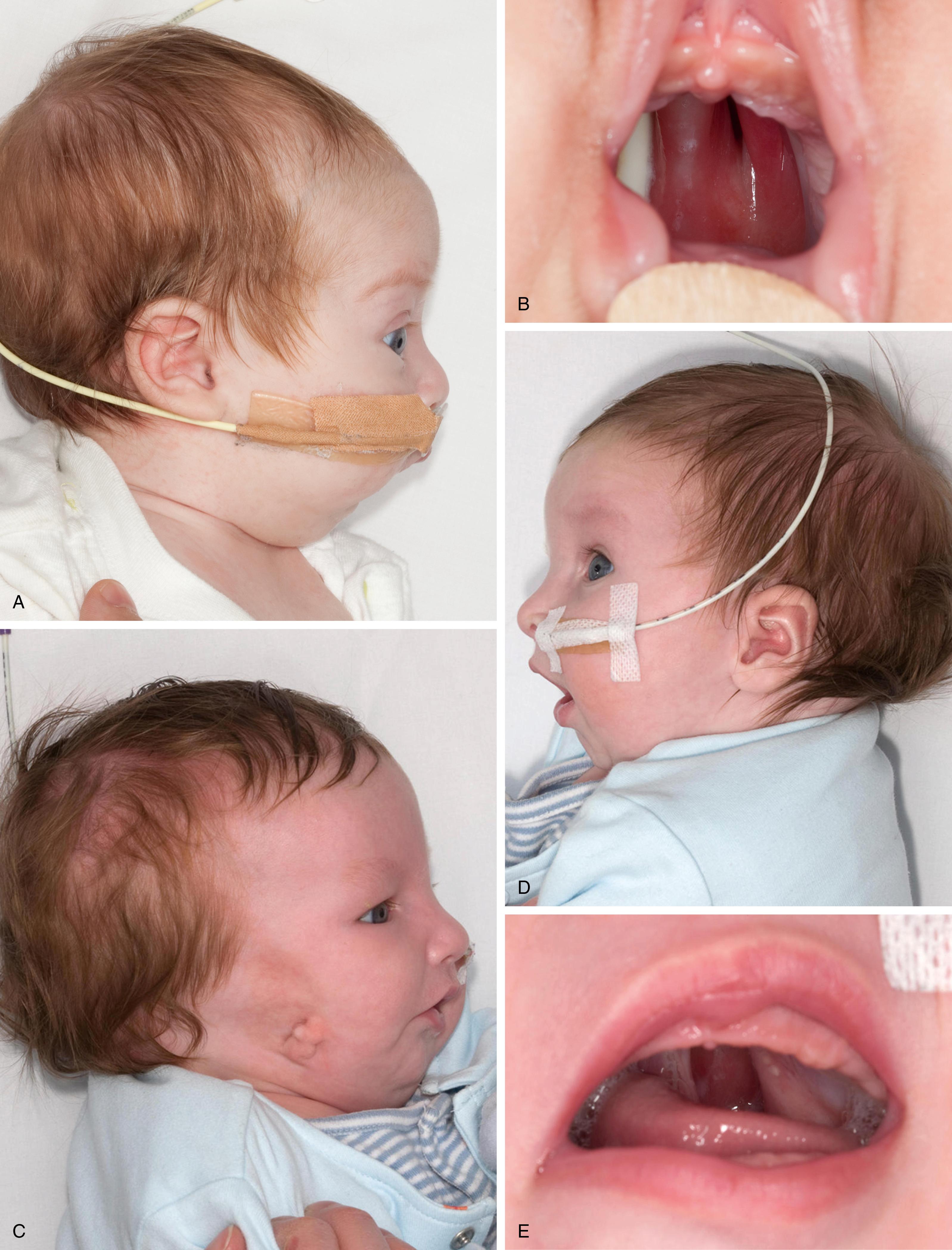 Fig. 17.4, Lateral photographs of infants with Pierre Robin sequence. (A) Nonsyndromic infant with severe micrognathia, nasopharyngeal airway and gavage tube in place. (B) A typical U-shaped cleft palate. (C, D) Infant with Pierre Robin sequence with right-sided craniofacial microsomia and microtia. (E) In this case, there is a cleft of the soft palate only.