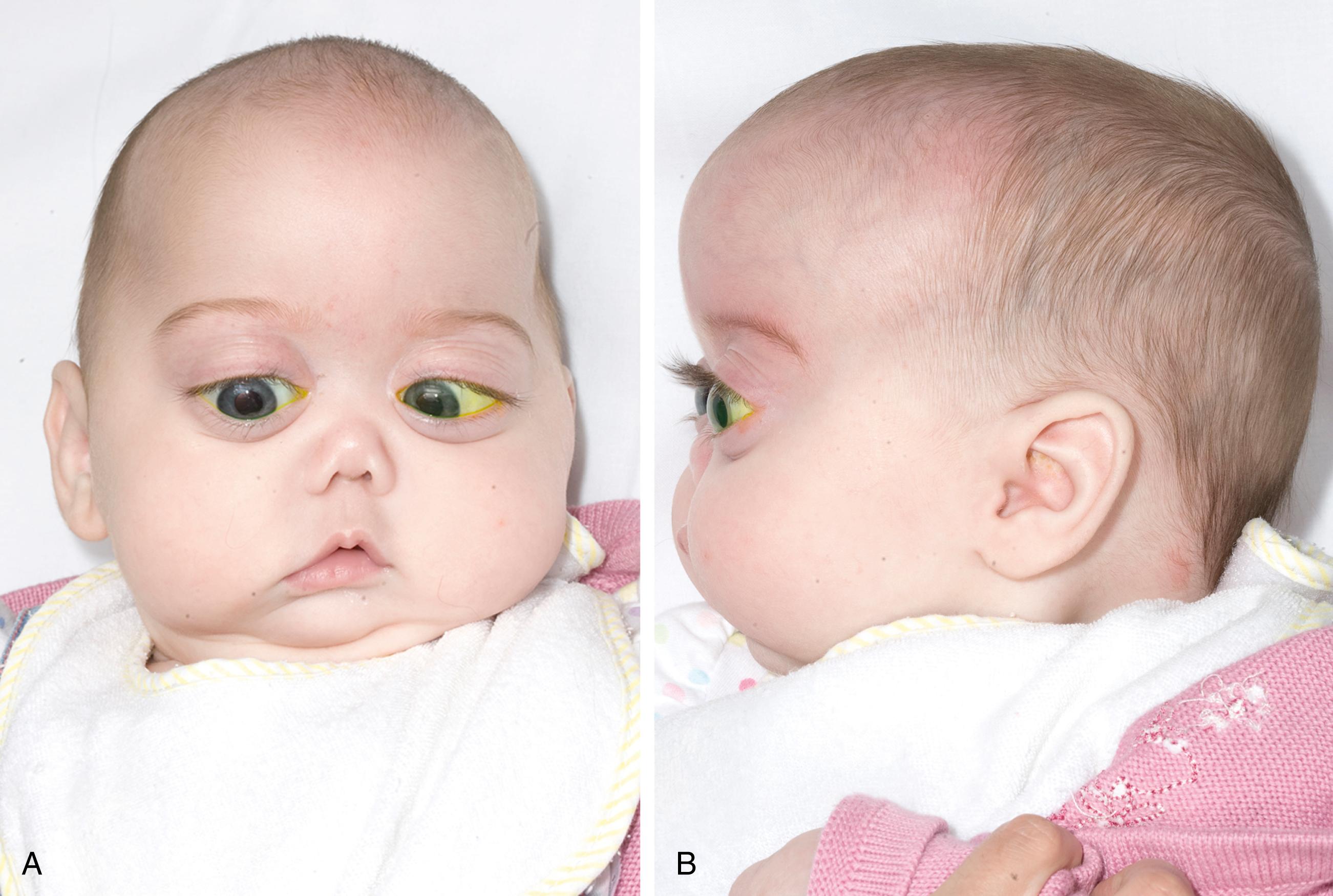 Fig. 17.5, Clinical image of infant with Stickler syndrome. Note the facial features characteristic of this syndrome, including prominent eyes, flat nasal bridge, anteverted nares, and mid-face hypoplasia. (A) anterior and (B) lateral views.