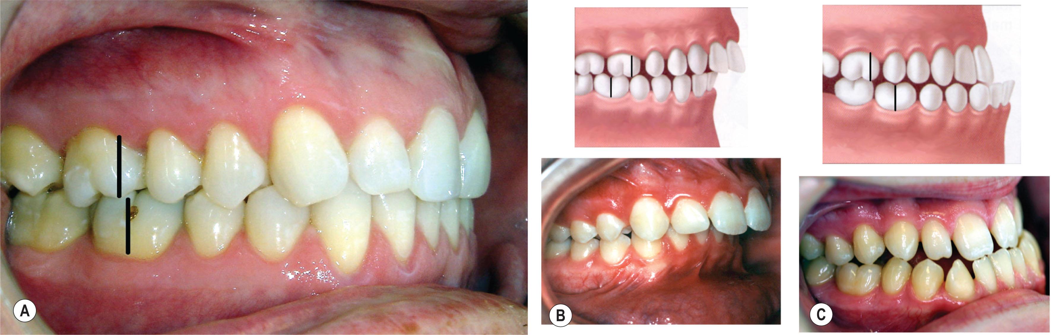 Figure 21.11.1, (A) Class I occlusion has a normal molar relationship. (B) Class II malocclusion is characterized by the mesiobuccal cusp of the maxillary first molar sitting mesial to the mesiobuccal groove of the mandibular first molar. (C) Class III malocclusion is characterized by the mesiobuccal cusp of the maxillary first molar sitting distal to the mesiobuccal groove of the mandibular first molar.