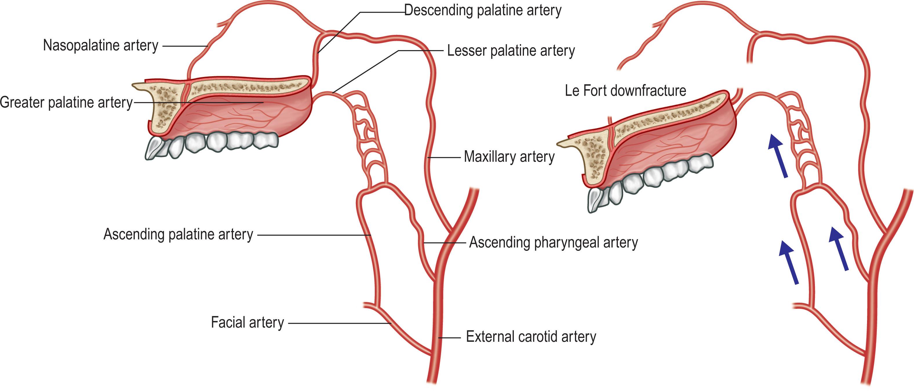 Figure 21.11.2, Blood supply to maxilla before (left) and after (right) Le Fort I osteotomy and downfracture. After the nasopalatine and descending palatine arteries are transected, perfusion of the maxillary segment occurs via the lesser palatine artery.