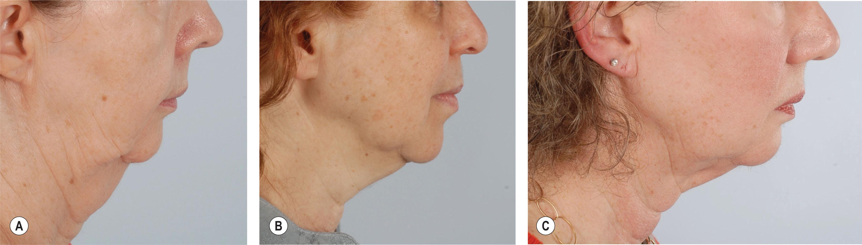 Figure 21.11.4, (A–C) In the mature patient, insufficient skeletal support from uncorrected skeletal dysplasia leads to a prematurely aged facial appearance leading many patients to pursue facial rejuvenation procedures to improve soft-tissue laxity.