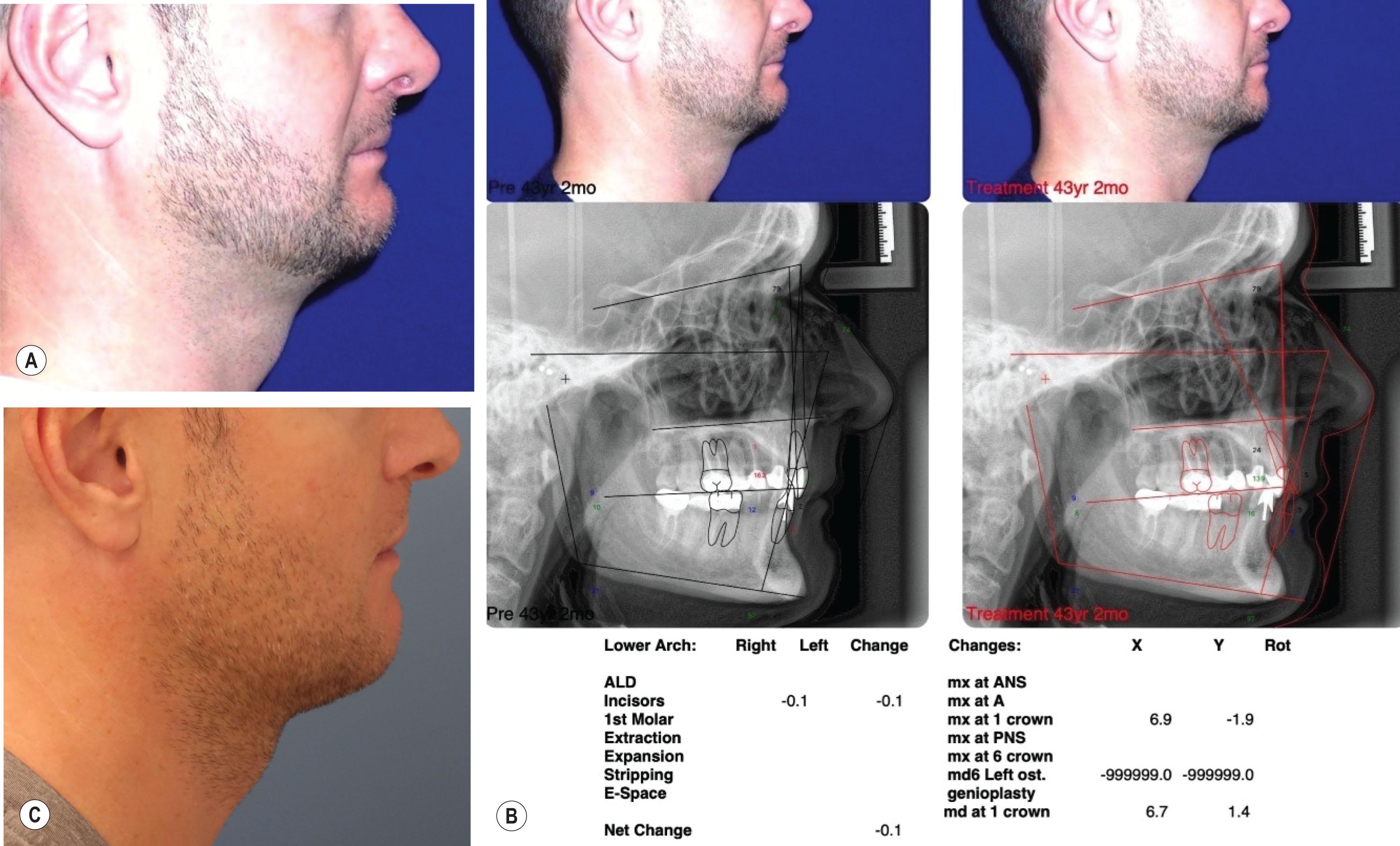 Figure 21.11.5, (A–C) This patient presented for a necklift with a primary complaint of a short neck to chin distance and an obtuse cervicomental angle. His profile was a result of compensatory orthodontic therapy that corrected a skeletal class II occlusion without mandibular advancement. An advancement genioplasty was not an option given pogonion was anterior to the lower lip and he exhibited a deep labiomental crease. He was referred to an orthodontist to be evaluated for orthodontic decompensation followed by mandibular advancement but declined for financial reasons. He was treated successfully by slightly lengthening and clockwise rotation genioplasty with submental liposuction and a corset platysmaplasty.