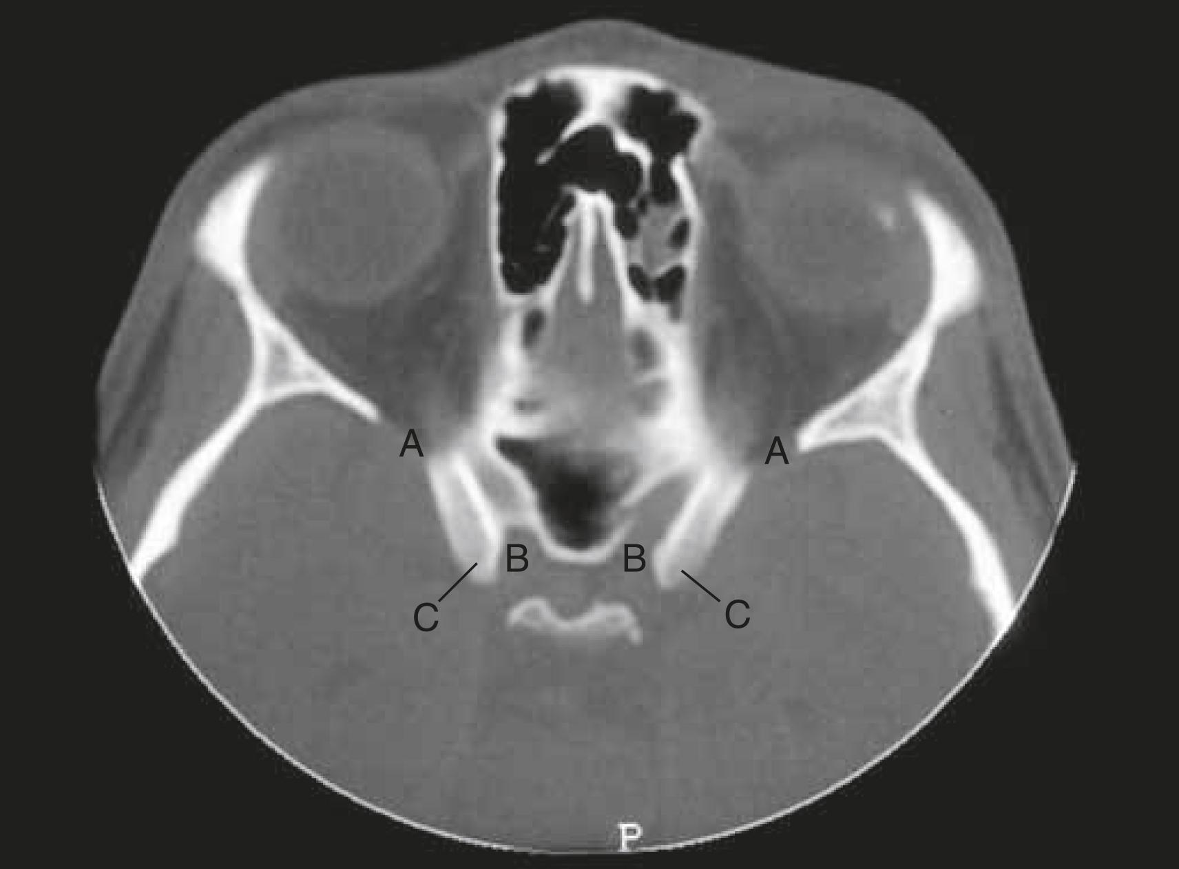 Figure 2.14, Axial CT scan of orbit. A , Superior orbital fissure. B , Optic canal. C , Anterior clinoid process. You can see how the inferior extension of the anterior clinoid process, the optic strut, separates the optic canal from the superior orbital fissure. When you want to identify the optic canal, find the scan that shows the anterior clinoid process.