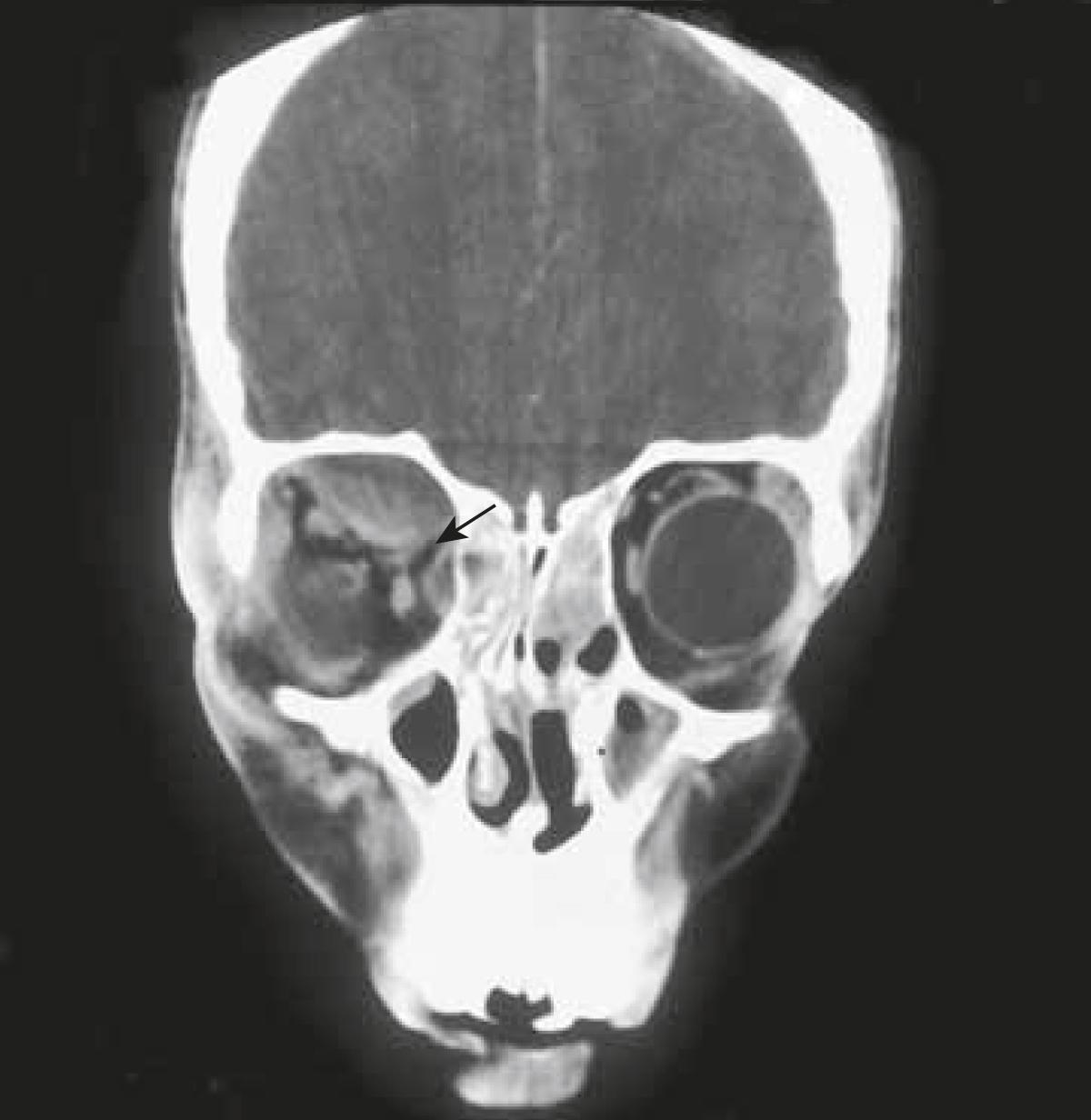 Figure 2.15, Subperiosteal abscess on the orbital roof and the medial wall of the orbit attributable to ethmoid sinus infection. Note how the abscess elevates the periorbita to form a dome. The periorbita remains fixed to the frontoethmoid suture ( arrow ), making two abscess spaces.