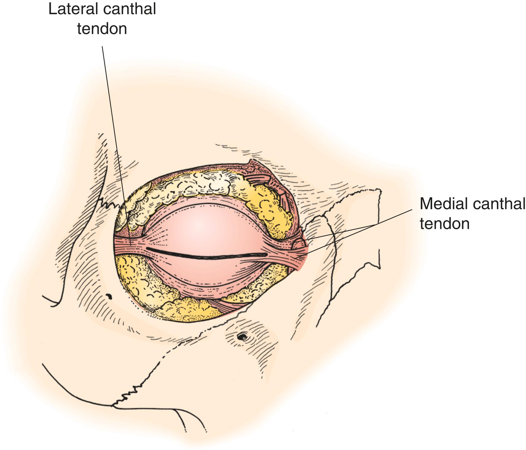 Figure 2.19, The canthal tendons.