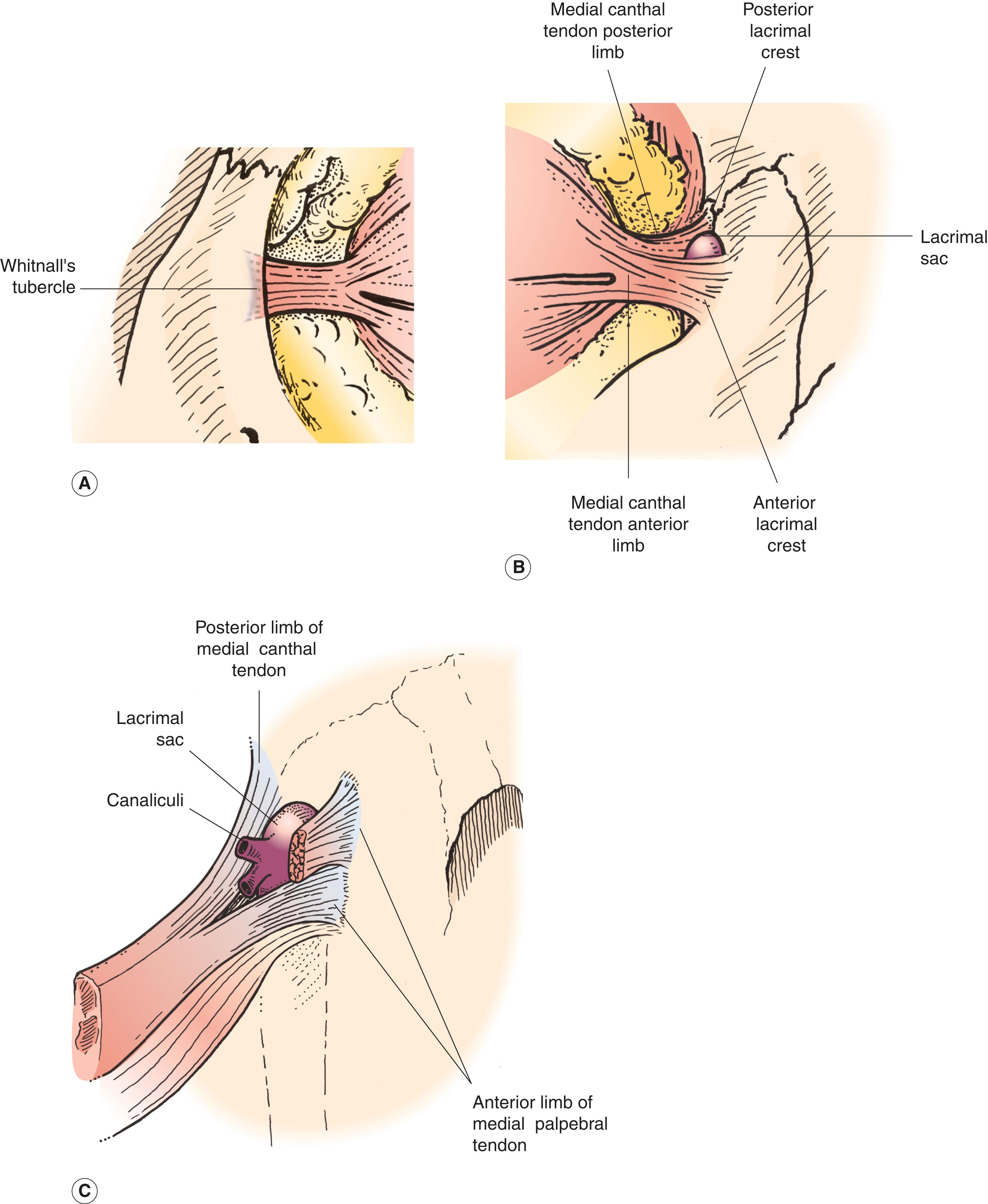 Figure 2.20, ( A ) The lateral canthal tendon. ( B ) The medial canthal tendon. ( C ) The medial canthal tendon complex surrounding the lacrimal sac.