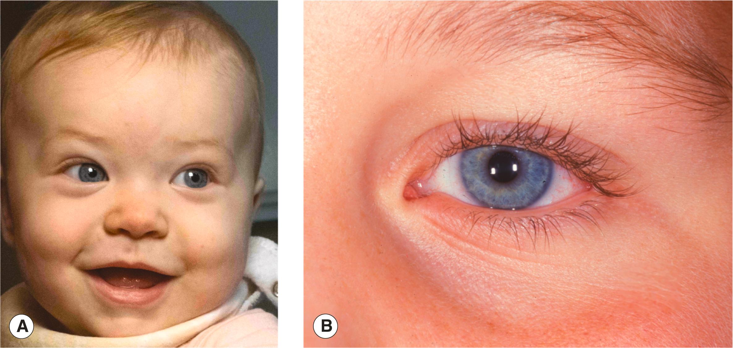 Figure 2.2, Features of the youthful face. ( A ) The round, long, smooth curves of the full baby face with graceful transitions from one part of the face to another. ( B ) The lower eyelid crease, usually seen only in children.