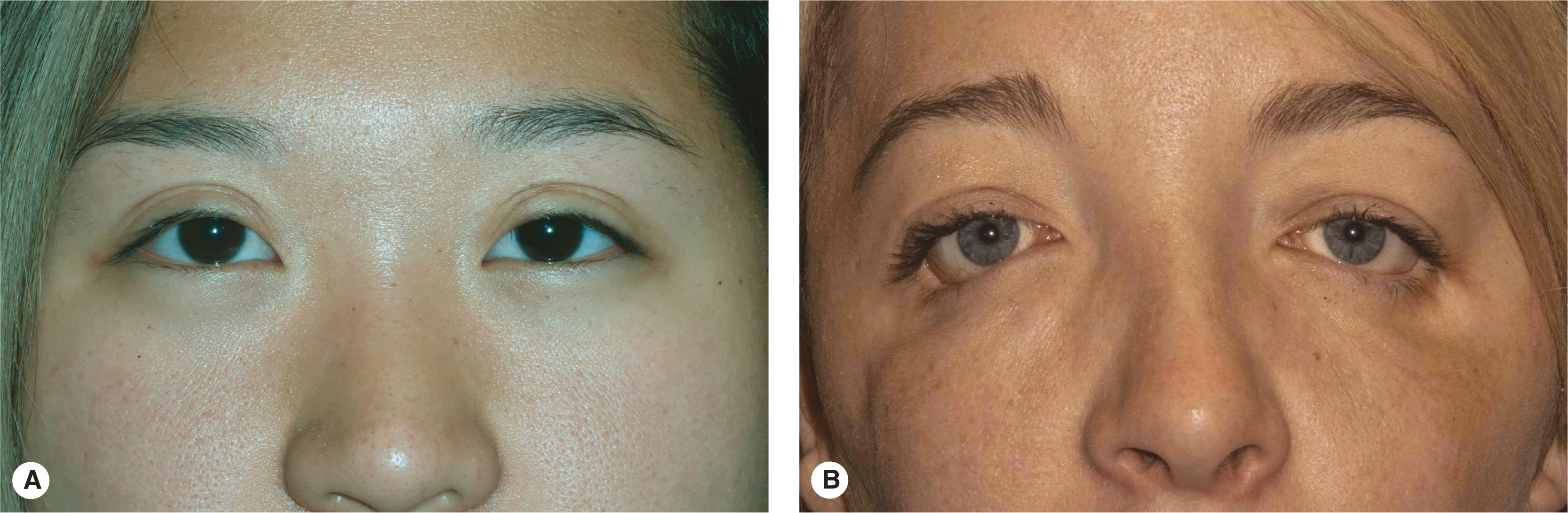 Figure 2.21, Eyelid slope. The normal slope of the eyelids varies widely. ( A ) The normal slope of the eyelids is the lateral canthus at or slightly higher than the medial canthus. ( B ) Antimongoloid fissure: The lateral canthal attachment is lower than the medial canthal attachment. This is a case of Treacher Collins syndrome. The poorly developed zygoma results in a lateral canthal dystopia.