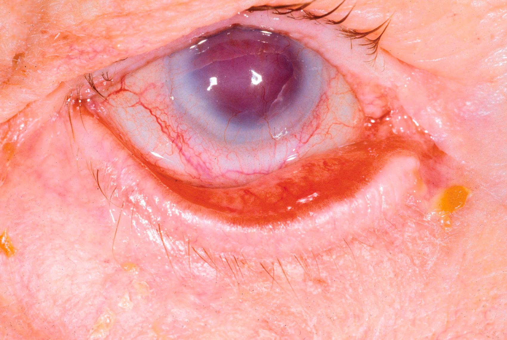 Figure 2.22, Involutional ectropion of the lower eyelid caused by horizontal lid laxity, the result of stretching of the canthal tendons.