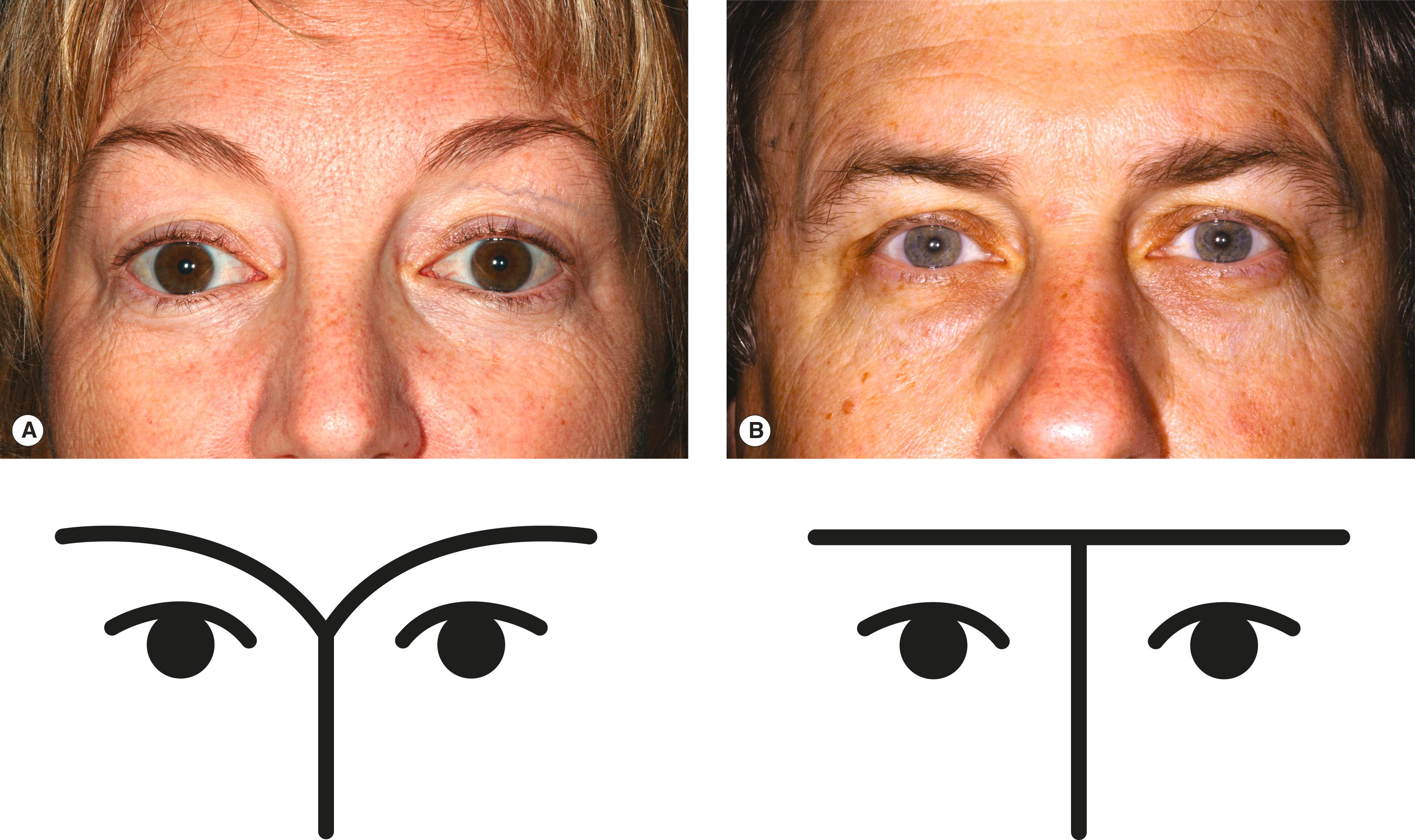 Figure 2.4, Normal eyebrow contour. ( A ) Female. ( B ) Male.