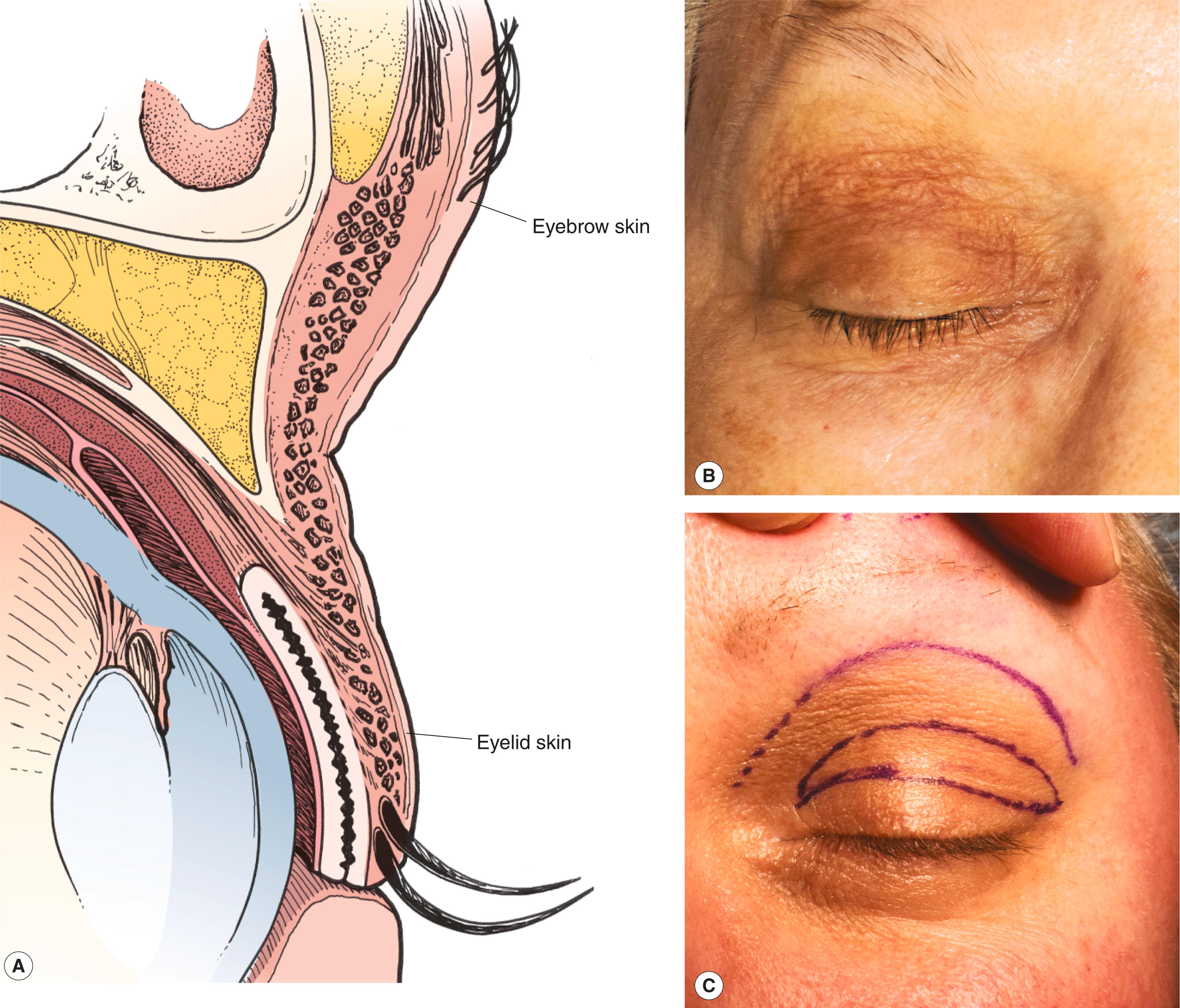 Figure 2.6, ( A ) Eyelid pigmentation, thickness, and texture. Eyebrow skin is thicker than eyelid skin, which is seen a few millimeters inferior to the eyebrow hairs. Often the eyelid skin is darker than the eyebrow skin. ( B ) In this patient, the eyelid skin is darker, thinner, and more wrinkled than the eyebrow skin. ( C ) In another patient, who is younger than the patient in panel A , the eyelid skin is also darker and thinner than the eyebrow skin. The eyelid shows few wrinkles. It is important to recognize this difference so you can better diagnose an eyebrow ptosis. At the time of blepharoplasty, it helps you avoid taking too much eyelid skin. The ellipse shows the amount of eyelid skin to be removed for a blepharoplasty. The upper line is the junction of the eyelid and eyebrow skin. Notice that the junction is several millimeters inferior to the eyebrow hairs.
