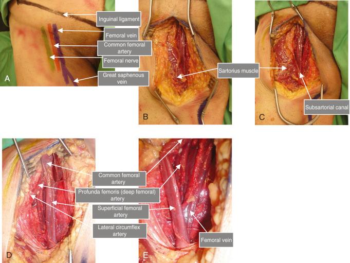 Figure 13.5, (A–E) Surgical exposure of the femoral vessels in the groin and proximal thigh.