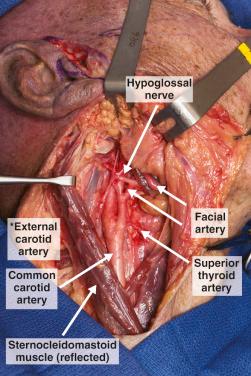 Figure 10.7, External carotid artery * with two of its branches.