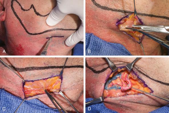 Figure 10.8, Exposure of the facial artery.