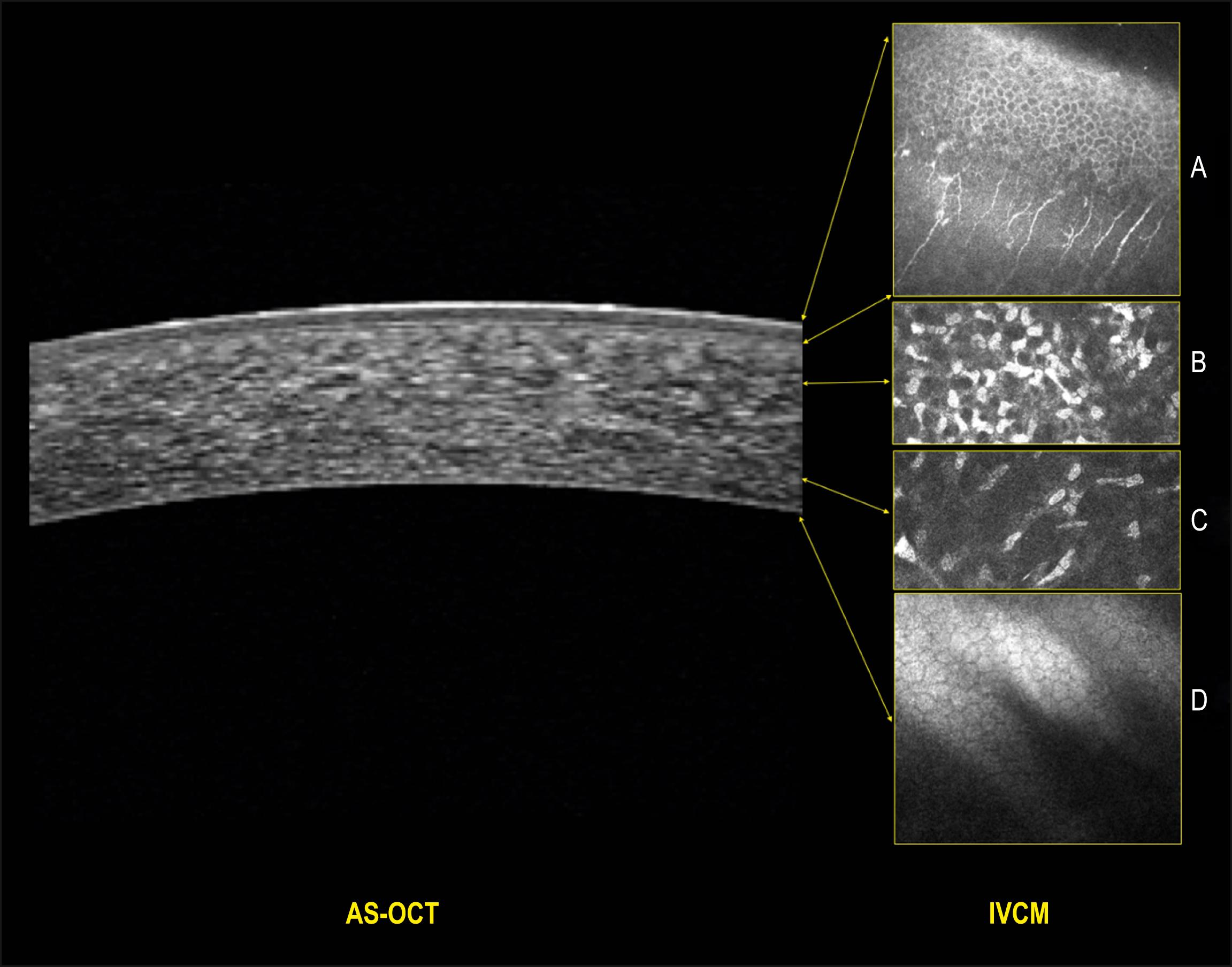 Fig. 15.1, Imaging of normal cornea by anterior segment optical coherence tomography (AS-OCT) and in vivo confocal microscopy (IVCM) using HRT 3 Rostock cornea module (Heidelberg, Germany).