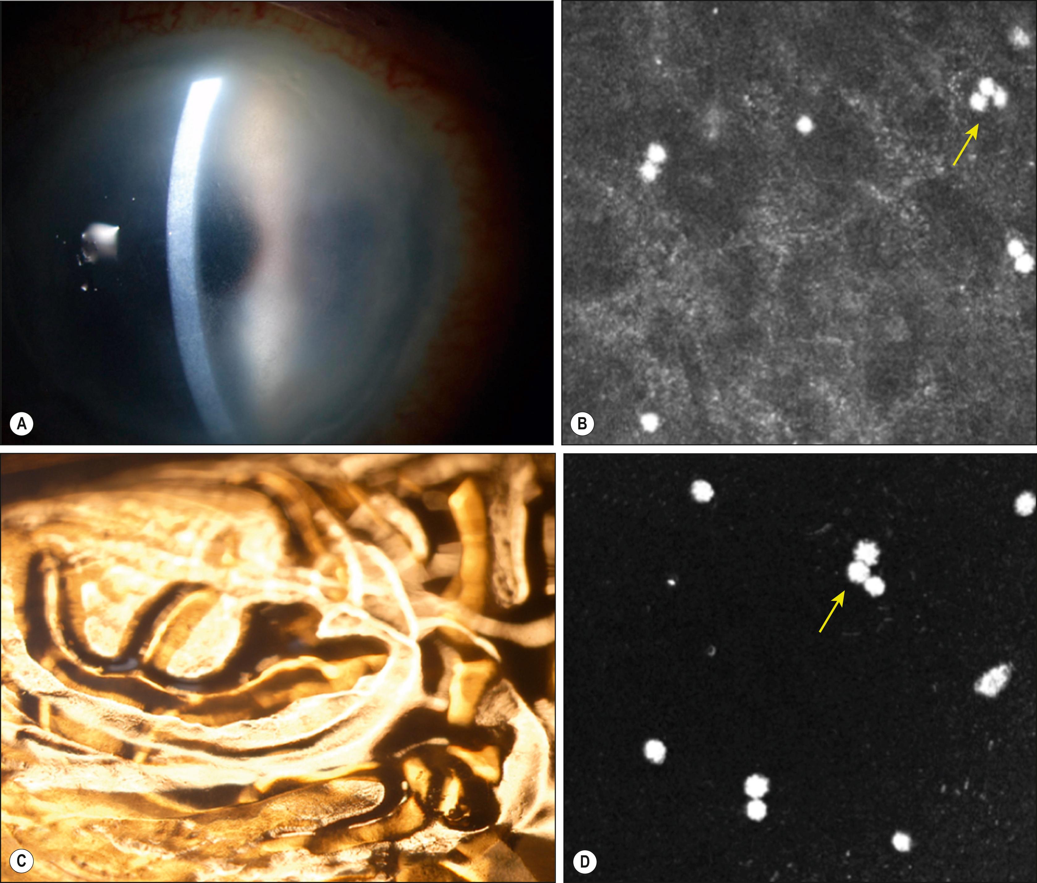 Fig. 15.2, Acanthamoeba keratitis.