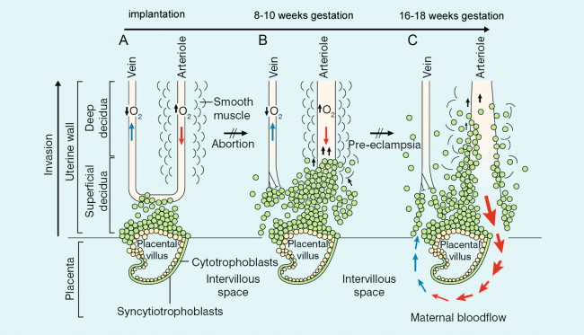 FIGURE 15-1, Endovascular trophoblast invasion into the endometrium occurs in two waves: (A) shows the situation shortly after implantation; (B) at 8–10 weeks the decidual segments of the spiral arteries are invaded; (C) at 16–18 weeks the myometrial segments are invaded. This results in low resistance to blood flow on the maternal side of the placental bed in a normal pregnancy.