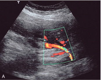 FIGURE 15-2, (A) Course of the left uterine artery as it crosses over the iliac vessels. (B) Normal uterine artery flow in the early third trimester demonstrating high diastolic flow.