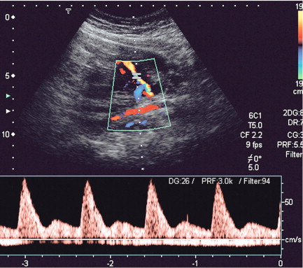 FIGURE 15-3, Uterine artery waveform in intrauterine growth retardation demonstrating low diastolic flow and an early diastolic notch.