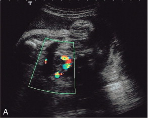 FIGURE 15-5, (A) Relative oligohydramnios. Colour flow Doppler demonstrating umbilical arteries in the pelvis on either side of an empty bladder. (B) Relative oligohydramnios sampling from the umbilical artery within the pelvis demonstrates normal umbilical artery flow patterns.