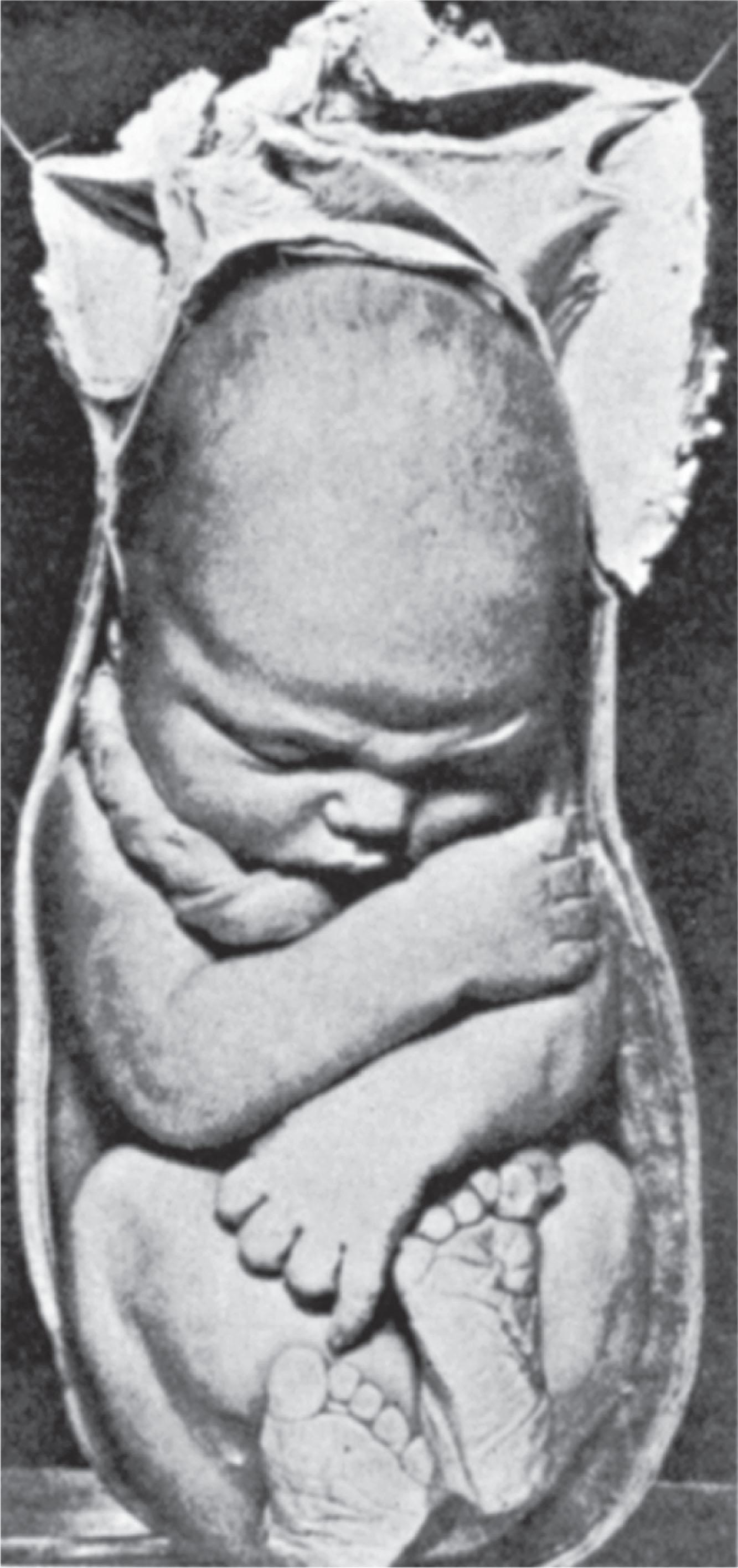 FIGURE 1.6, A primigravida’s term fetus in breech position illustrates the uterine constraint that is a feature of late fetal life and this mode of presentation. The mother was killed in a motor vehicle accident, and the fetus was dead on arrival at the hospital.