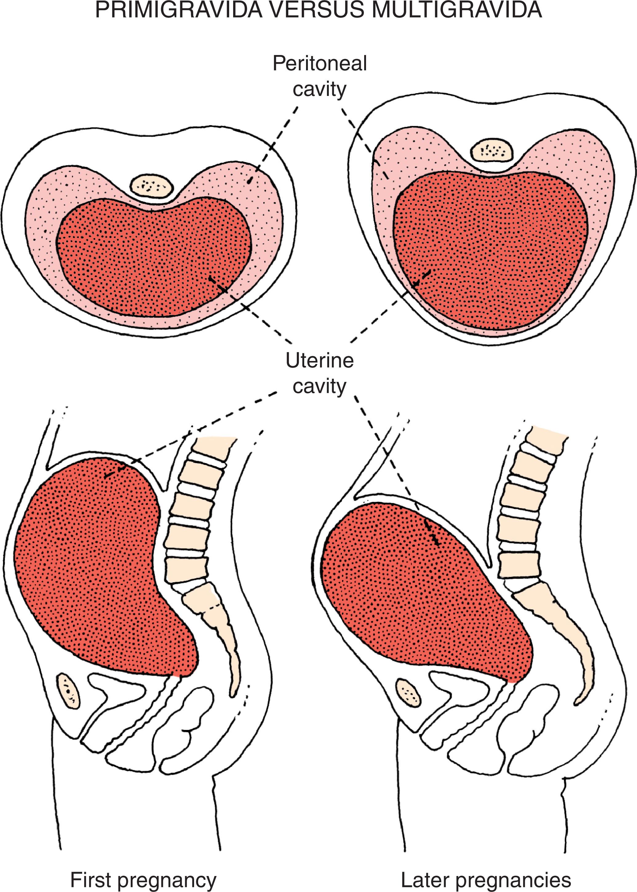 FIGURE 1.8, Transverse and sagittal section diagrams of the abdomens of primigravida and multigravida women illustrate the impact of unstretched abdominal muscles on the shape of the uterine cavity during the later weeks of pregnancy.