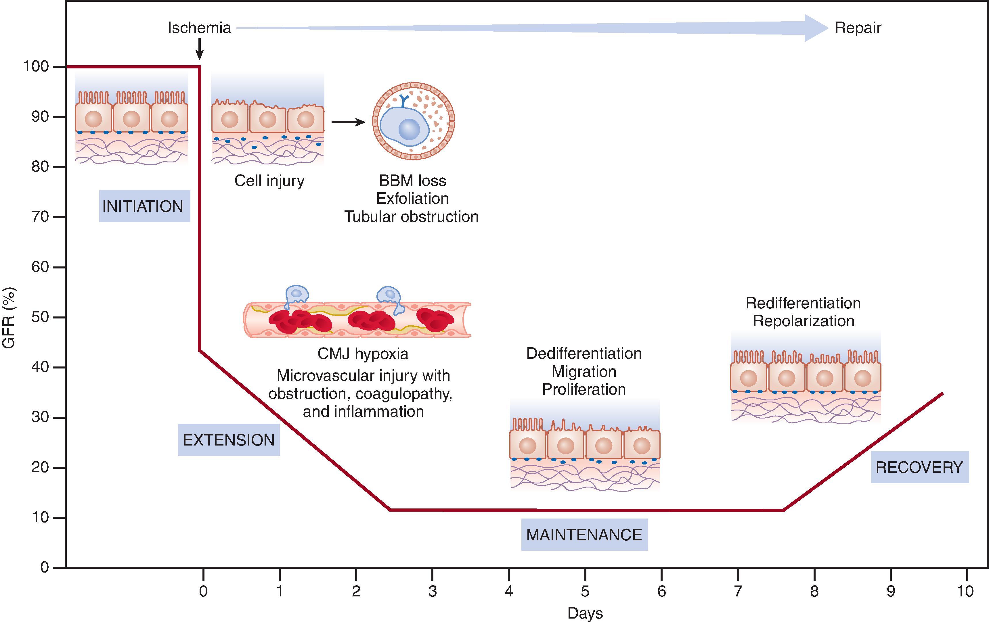 Fig. 31.2, Relationship between the clinical phases and the cellular phases of ischemic acute kidney injury (AKI) and the temporal impact on organ function as represented by glomerular filtration rate (GFR). A variety of cellular and vascular events are involved in the development of AKI. The initiation phase occurs when a reduction in kidney blood flow results in cellular injury, particularly the renal tubular epithelial cells, and a decline in GFR. Vascular and inflammatory processes that contribute to further cell injury and further decline in GFR usher in the extension phase. During the maintenance phase, GFR reaches a stable nadir as cellular repair processes are initiated to maintain and reestablish organ integrity. The recovery phase is marked by a return of normal cell and organ function that results in an improvement in GFR. BBM, Brush border membrane; CMJ, corticomedullary junction. (Data from Basile DP, Anderson MD, Sutton TA. Pathophysiology of acute kidney injury. Compr Physiol . 2012;2:1303–1353.)