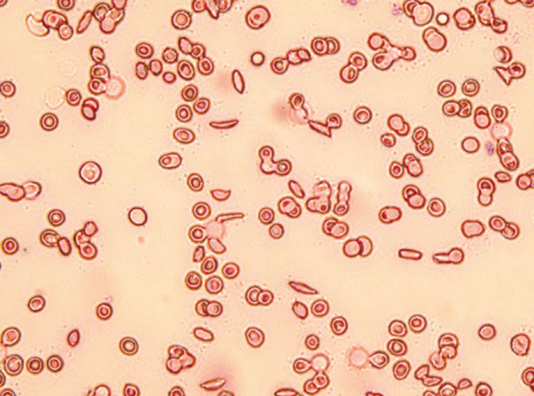 Figure 43.4, The peculiar elongated shapes of the erythrocytes is what Herrick's intern Ernest E. Irons noted, and together with a report from the German literature of sichel formen blood cells, inspired the name by which this condition is now known.