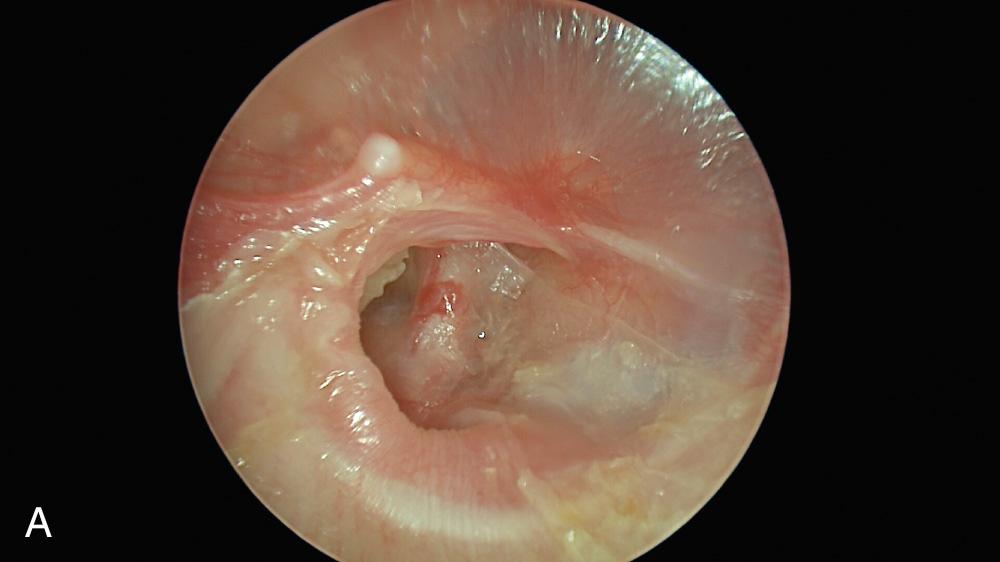 Fig. 145.2, (A) Tympanic membrane (TM) perforation with ossicular discontinuity. (B) Right-sided conductive hearing loss of TM perforation with ossicular discontinuity.