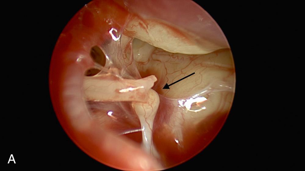 Fig. 145.3, (A) Incudostapedial joint erosion. (B) Right-sided conductive hearing loss of incudostapedial joint separation.