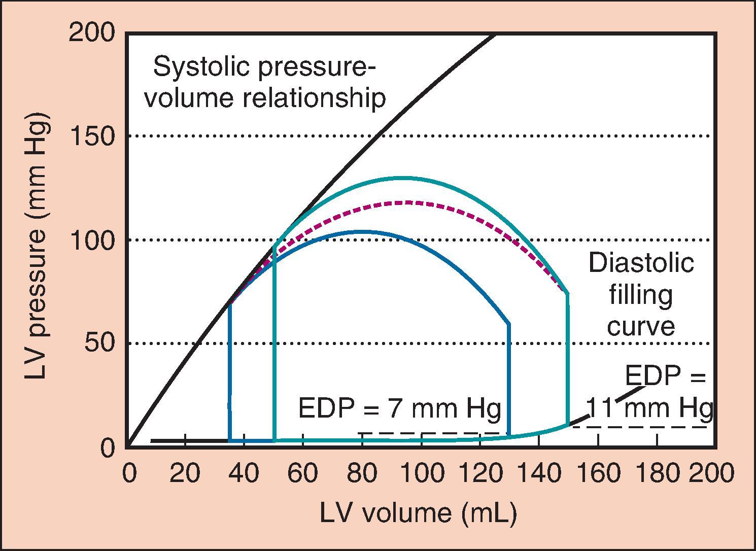 Fig. 5.4, Changes in the cardiac cycle that can occur with vasodilatation are depicted. The cycle in green is the same cycle shown in Fig. 5.3 . The red dashed line suggests the transition to the new cardiac cycle shown in blue. The systolic blood pressure has decreased to 105 mm Hg. The end-systolic volume has decreased, as has the end-diastolic volume. End-diastolic pressure (EDP) has decreased from 11 to 7 mm Hg in this example. The ejection fraction is slightly increased; however, the stroke volume may decrease, but with restoration of left ventricular (LV) filling pressures to the same level as before, the stroke volume will be higher.