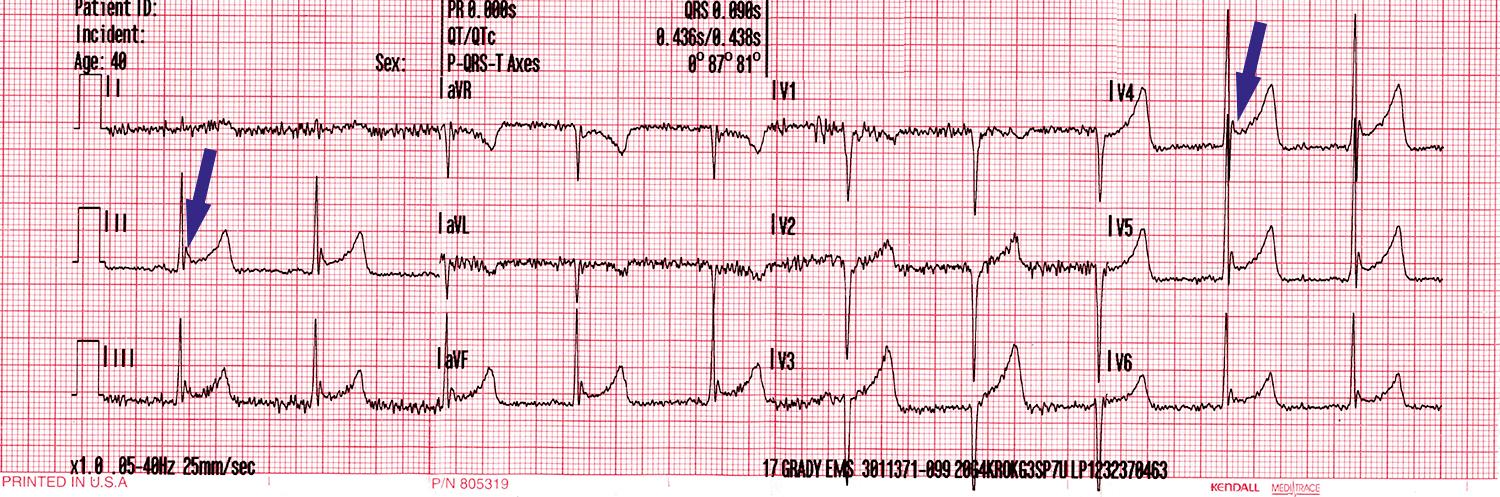 Fig. 75.2, Osborn waves in a hypothermic patient.