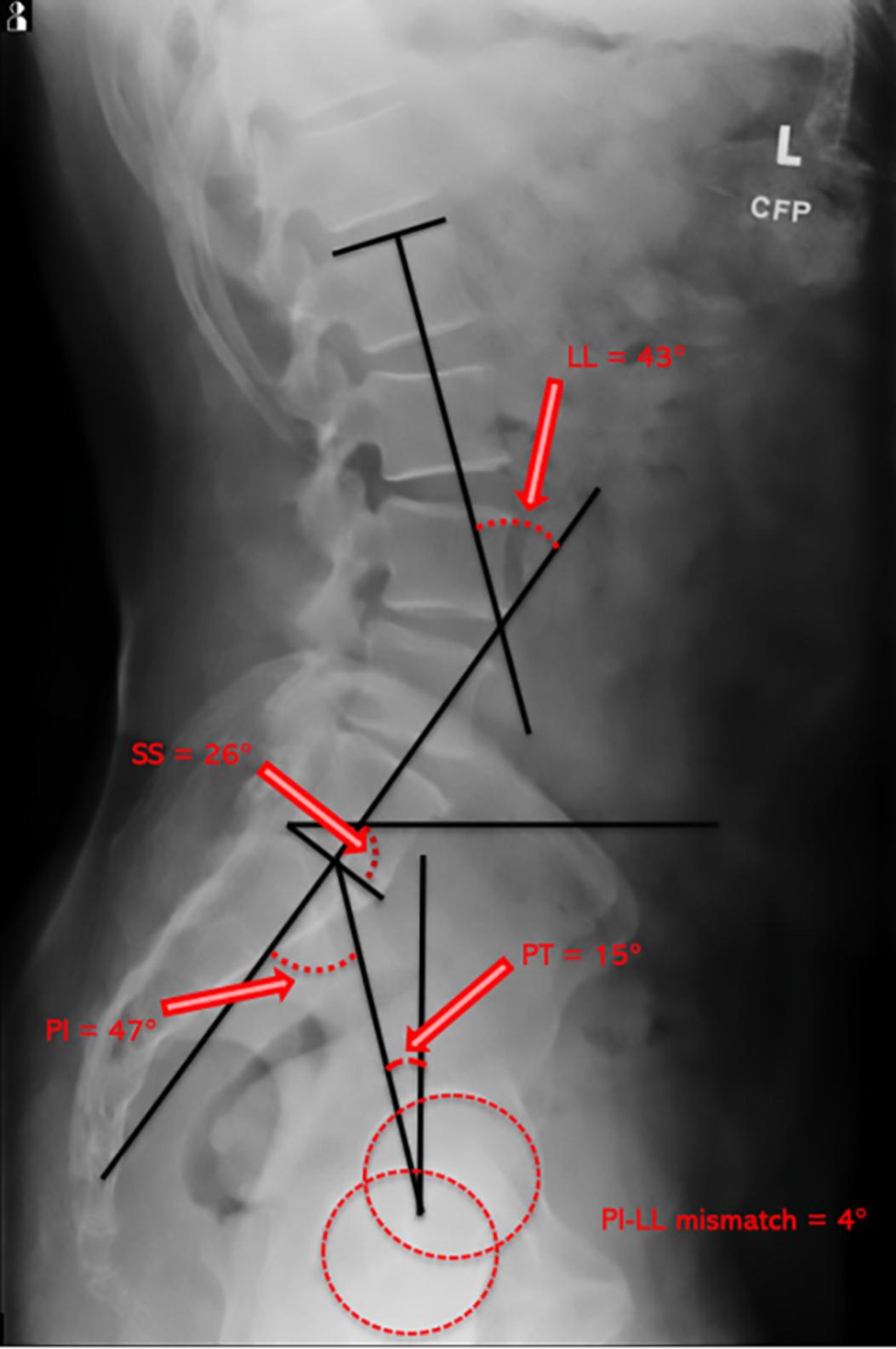 Fig. 1, Spinopelvic radiographic parameters. LL , lumbar lordosis; PI , pelvic incidence; PT , pelvic tilt; SS , sacral slope.