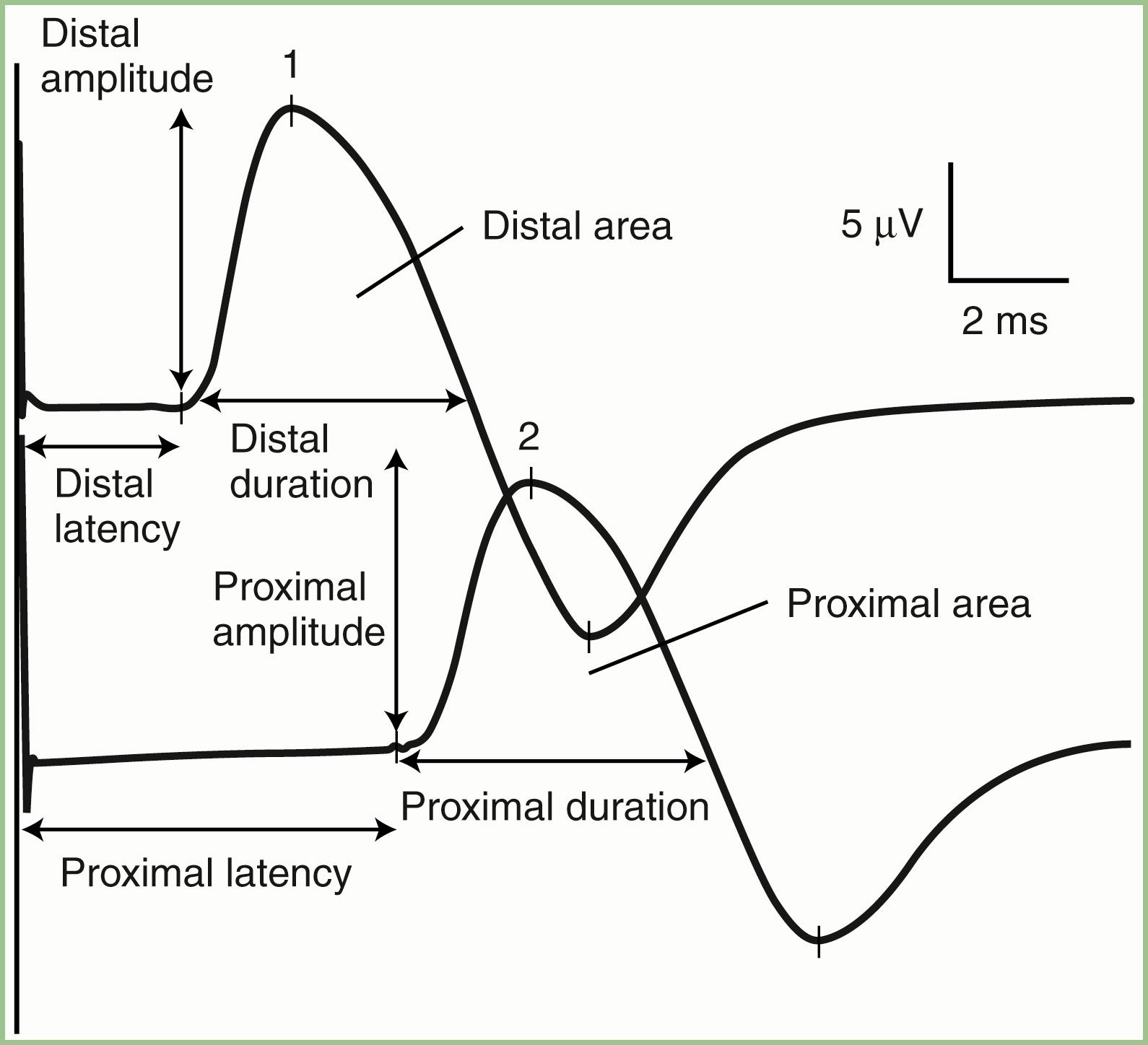 Fig. 36.1, Motor nerve conduction study of the median nerve, revealing a typical compound muscle action potential (CMAP) with distal (wrist) and proximal (elbow) stimulations; it shows the distal and proximal latencies and CMAP amplitudes, durations, and areas. The proximal CMAP has a lower amplitude (12.6 mV vs. 11.3 mV) and area (37.3 mV/ms vs. 34.50 mV/ms) than the distal CMAP because of physiological temporal dispersion and phase cancellation. The proximal conduction velocity is calculated by measuring the distance of the elbow-to-wrist segment and using the formula:Thus, for the conduction velocity in this example, 210 mm/6.9 ms − 3.5 ms = 62 m/sec. Motor conduction velocity=DistanceProximal latency−Distal latency Motor conduction velocity=DistanceProximal latency−Distal latency