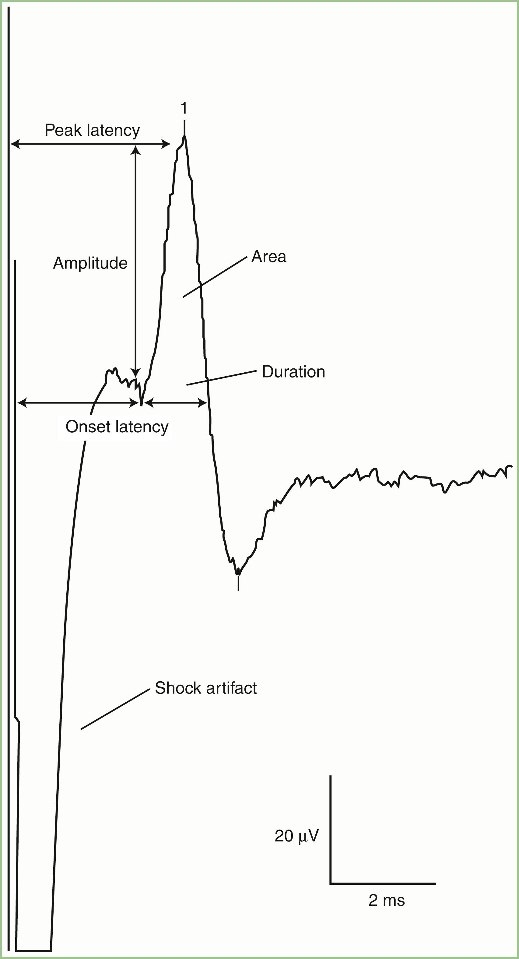 Fig. 36.2, Antidromic median sensory nerve conduction study after stimulation at the wrist, revealing peak and onset latencies and sensory nerve action potential amplitude, duration, and area. The shock artifact interferes with accurate determination of onset latency, whereas peak latency is easily determined.