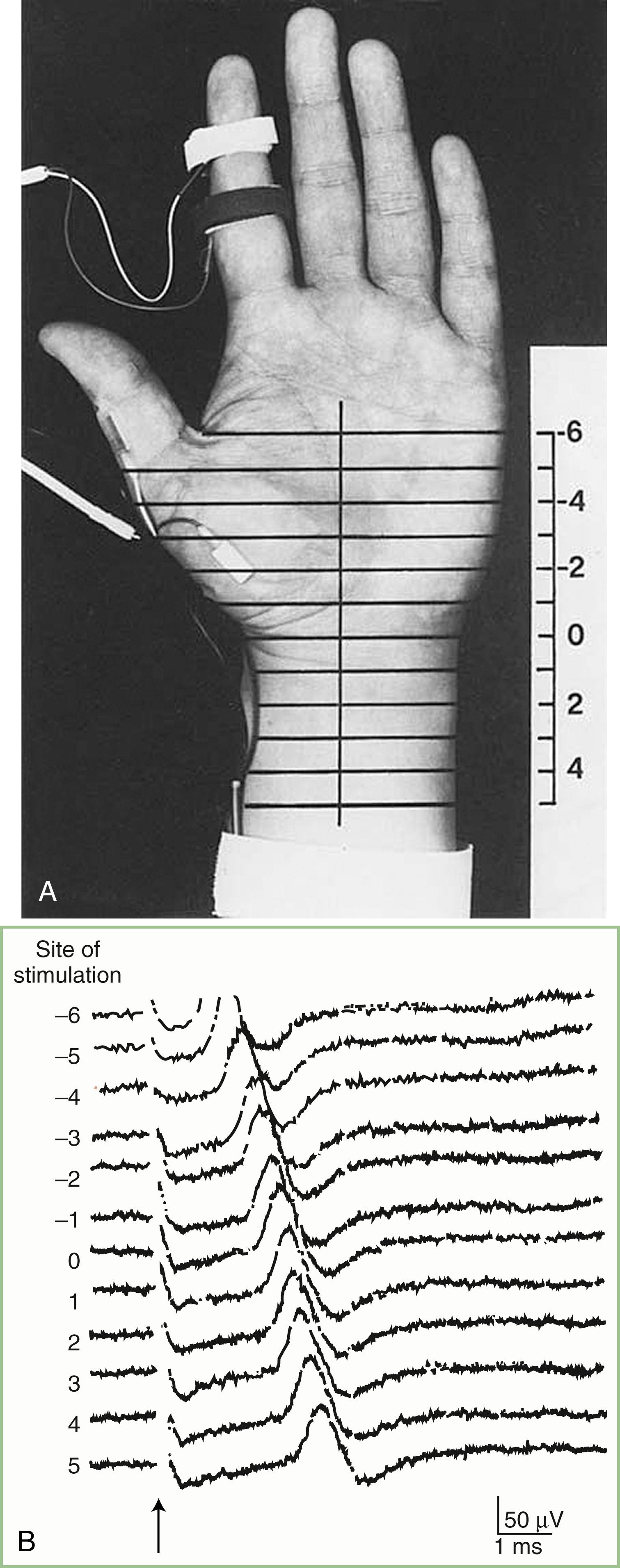 Fig. 36.3, A, Twelve sites of stimulation in 1-cm increments along the length of the median nerve. The 0 level is at the distal crease of the wrist, corresponding to the origin of the transverse carpal ligament. Sensory nerve action potentials (SNAPs) and compound muscle action potentials are recorded from the second digit and abductor pollicis brevis, respectively. B, SNAPs in a normal subject recorded after stimulation of the median nerve at multiple points across the wrist. The site of each stimulus is indicated on the left. The latency changes increased linearly (approximately 0.16–0.21 ms) as the stimulus site was moved proximally in 1-cm increments.