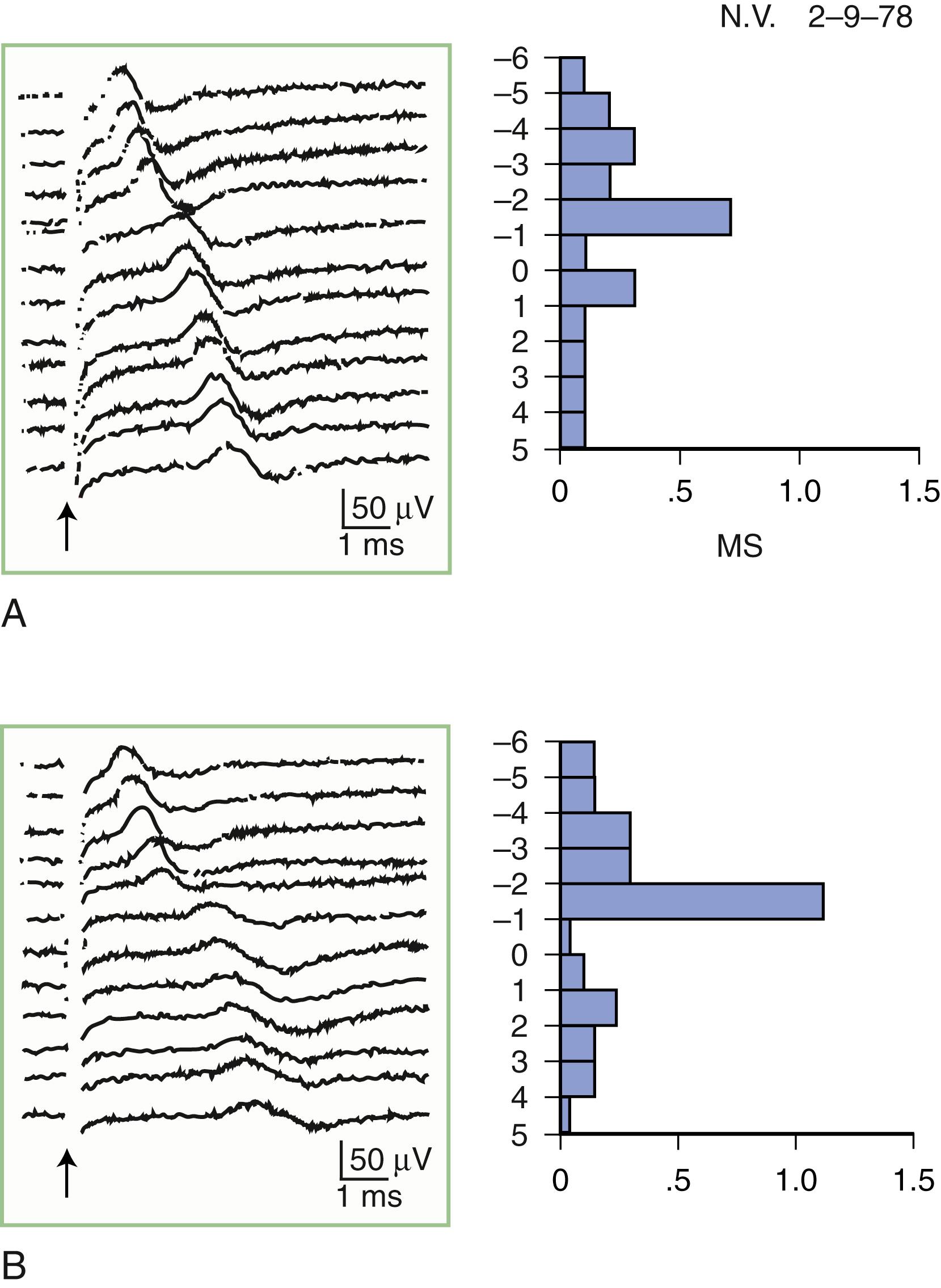 Fig. 36.4, Sensory nerve action potentials in a patient with bilateral carpal tunnel syndrome (see also Fig. 36.3 for settings). A sharply localized slowing was found from point −2 to point −1 in both hands, with a latency change measuring 0.7 ms on the left ( A ) and 1.1 ms on the right ( B ), compared with the other segments with normal latency changes of approximately 0.16–0.21 ms. Note also a distinct change in waveform of the sensory potential at the point of localized conduction delay.