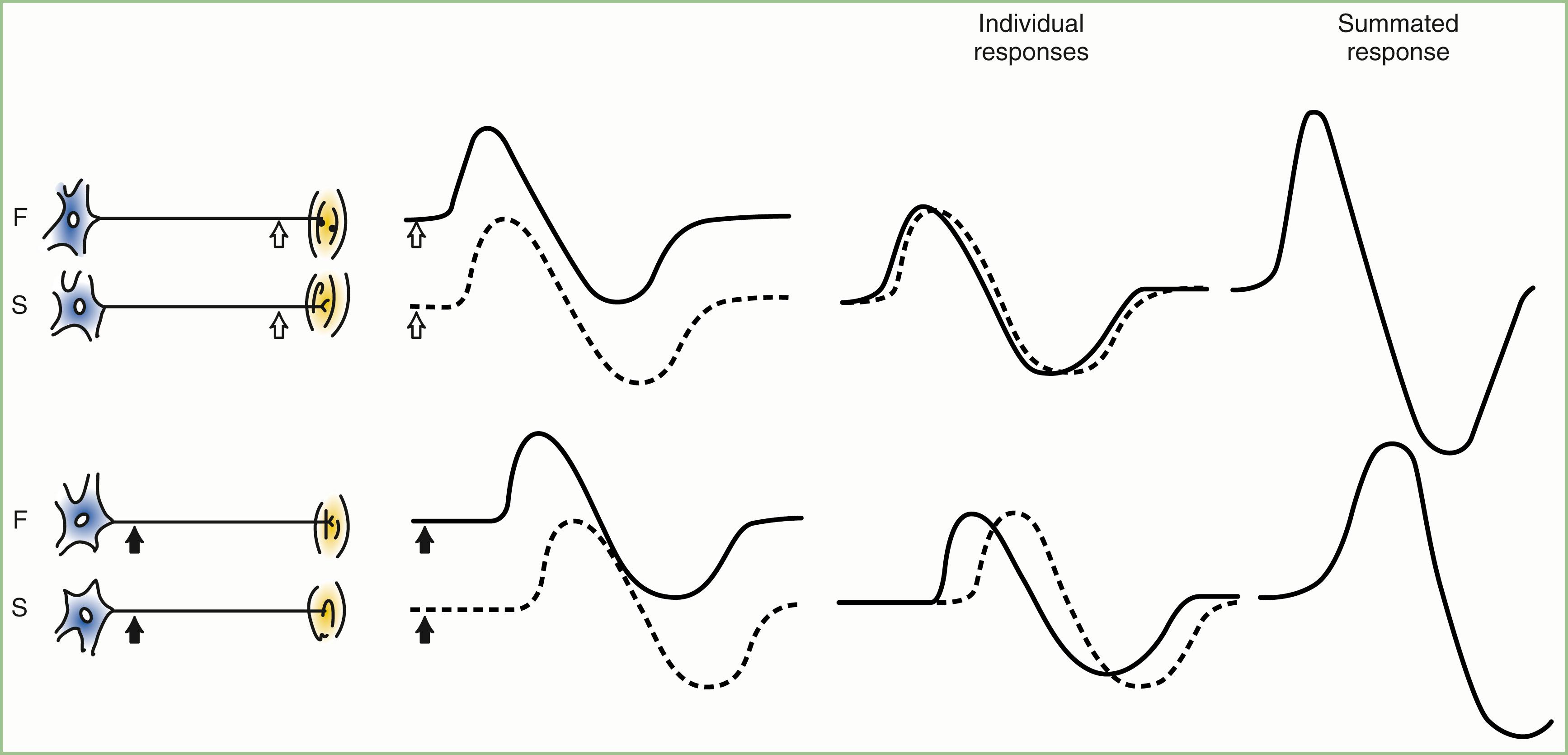 Fig. 36.5, Compound muscle action potentials showing the relationship between fast-conducting (F) and slow-conducting (S) motor fibers. With distal stimulation (top) , two unit discharges representing motor unit potentials sum to produce a muscle action potential twice as large. With proximal stimulation (bottom) , motor unit potentials of long duration still superimpose nearly in phase despite the same latency shift of the slow motor fiber. Thus, a physiological temporal dispersion alters the size of the muscle action potential only minimally if at all. Phase cancellation increases substantially when the latency difference between fast- and slow-conducting fibers is increased by a demyelinating neuropathy. This gives the false impression of motor conduction block.