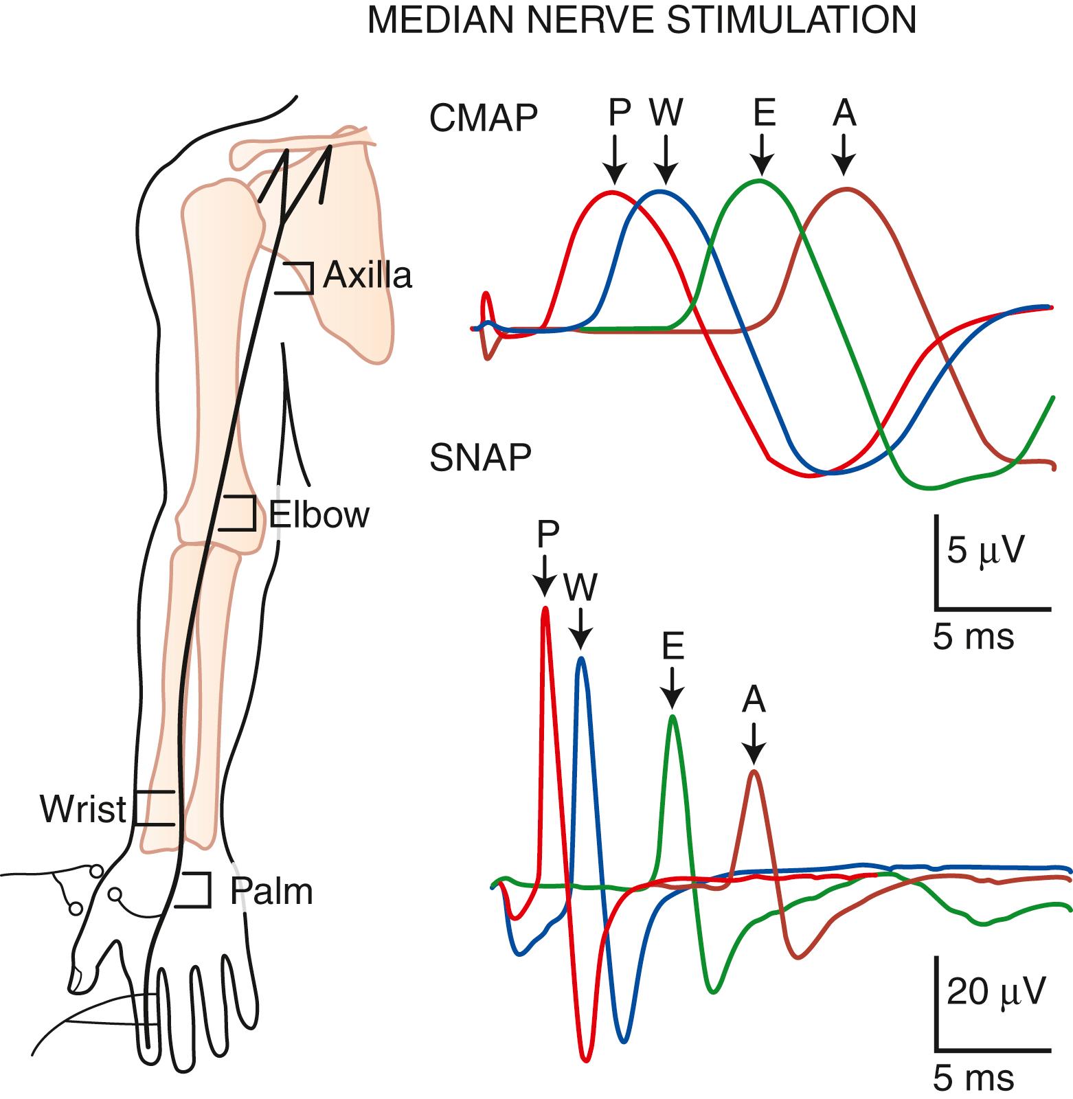 Fig. 36.6, Simultaneous recordings of compound muscle action potentials (CMAPs) from the thenar eminence and sensory nerve action potentials (SNAPs) from index finger after stimulation of the median nerve at palm (P) , wrist (W) , elbow (E) , and axilla (A) . With progressively more proximal stimulation, CMAPs remained nearly the same; for SNAPs, however, both amplitude and the area under the waveform became much smaller.