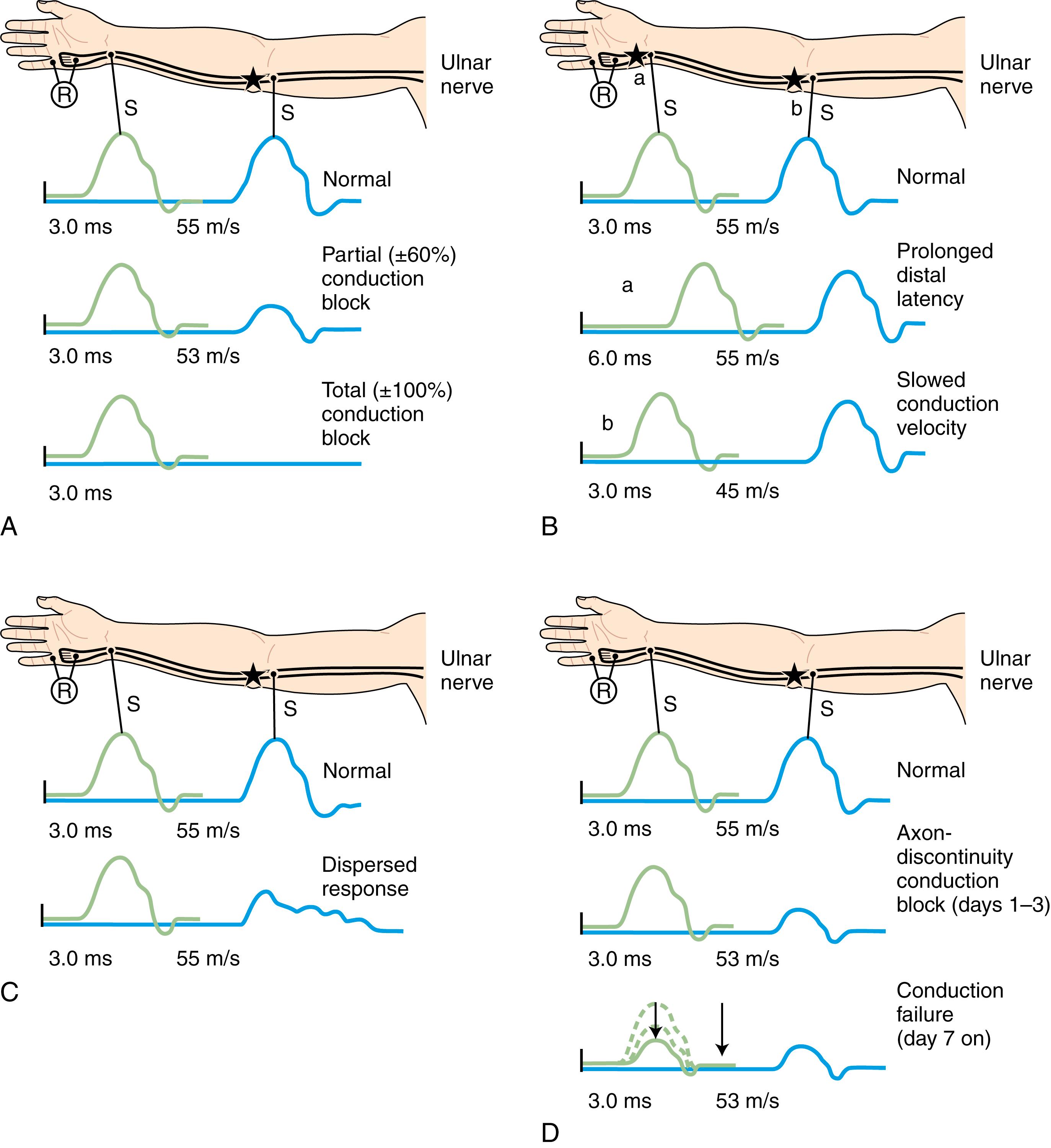 Fig. 36.8, Findings on Nerve Conduction Studies.