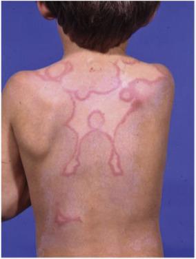 Fig. 3.1, Erythema marginatum in acute rheumatic fever demonstrating the characteristic pink rash with pale centres. Some of the margins are rounded while others are serpiginous.