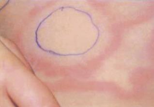 Fig. 3.2, Erythema marginatum demonstrating rapid migration: the pen mark shows the location of the rash around 60 min earlier.