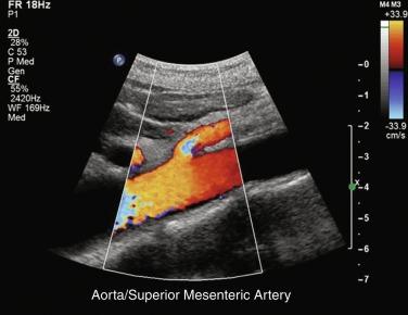 Fig. 26.1, Duplex ultrasonography of the aorta and superior mesenteric artery.