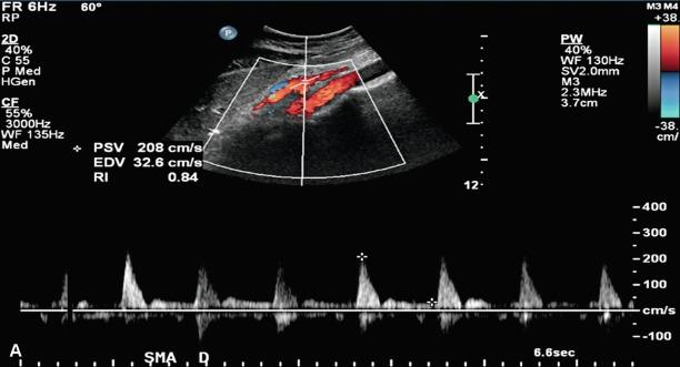 Fig. 26.2, (A) Duplex ultrasonography of the superior mesenteric artery (SMA) , with peak systolic velocity (PSV) of 208 cm/s signifying a normal SMA. (B) Duplex ultrasonography of the SMA with PSV of 389 cm/s signifying 70% or greater SMA stenosis. (C) Duplex ultrasonography of the celiac artery, with PSV of 331 cm/s signifying 70% or greater celiac artery stenosis.