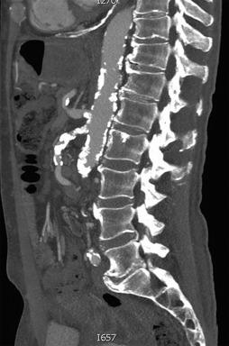 Fig. 26.3, Sagittal view of a computed tomographic angiogram demonstrating severe atherosclerotic disease of the proximal and mid-superior mesenteric artery.