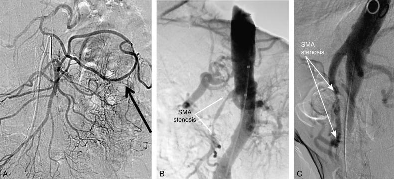 Fig. 26.4, (A) Anteroposterior aortogram demonstrating a hypertrophied collateral vessel (arrow) between the celiac artery and the superior mesenteric artery (SMA). (B) Lateral aortogram demonstrating long-segment stenosis of the SMA . (C) Lateral aortogram demonstrating long-segment stenosis of the middle SMA.