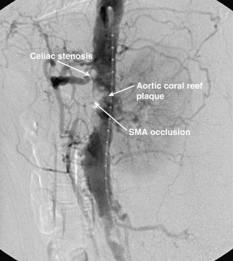 Fig. 26.5, Lateral aortogram demonstrating “coral reef” atherosclerotic plaque in aorta, with associated superior mesenteric artery (SMA) occlusion and celiac artery stenosis.