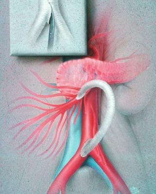 Fig. 26.6, Artist’s depiction of the infrarenal aorta–to–superior mesenteric artery bypass technique. Graft is fashioned using one limb of a bifurcated graft. After the inflow anastomosis is performed, the graft is arranged in an inverse “c” configuration.